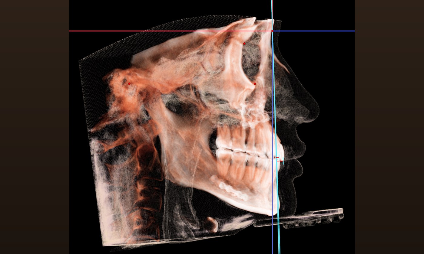 교정 진단에 사용하는 3D CT 측면 영상