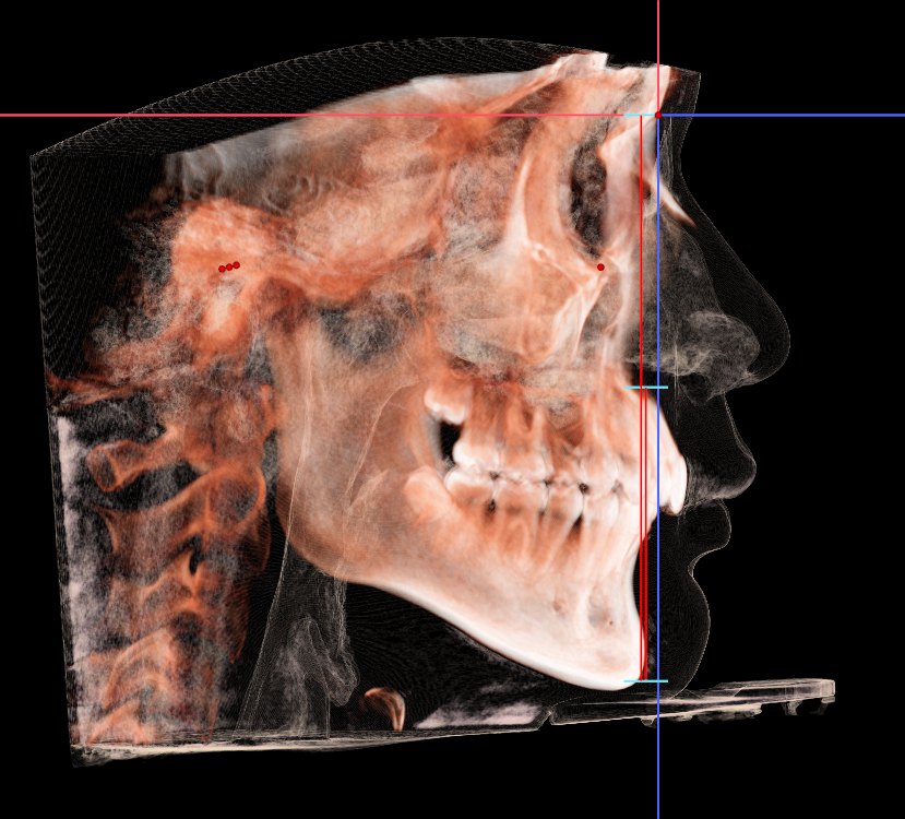 3D CT로 재구성한 측면 골격 영상 — 위턱과 아래턱의 위치 관계를 확인하는 진단 자료