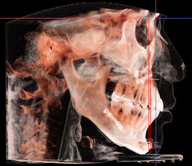 수술교정(협진)을 마친 뒤 3D CT 측면 재구성 영상(증례)